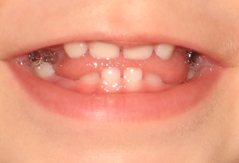 Baby Teeth: How to Help Kids Come to Grips with Losing Teeth - Mom Does