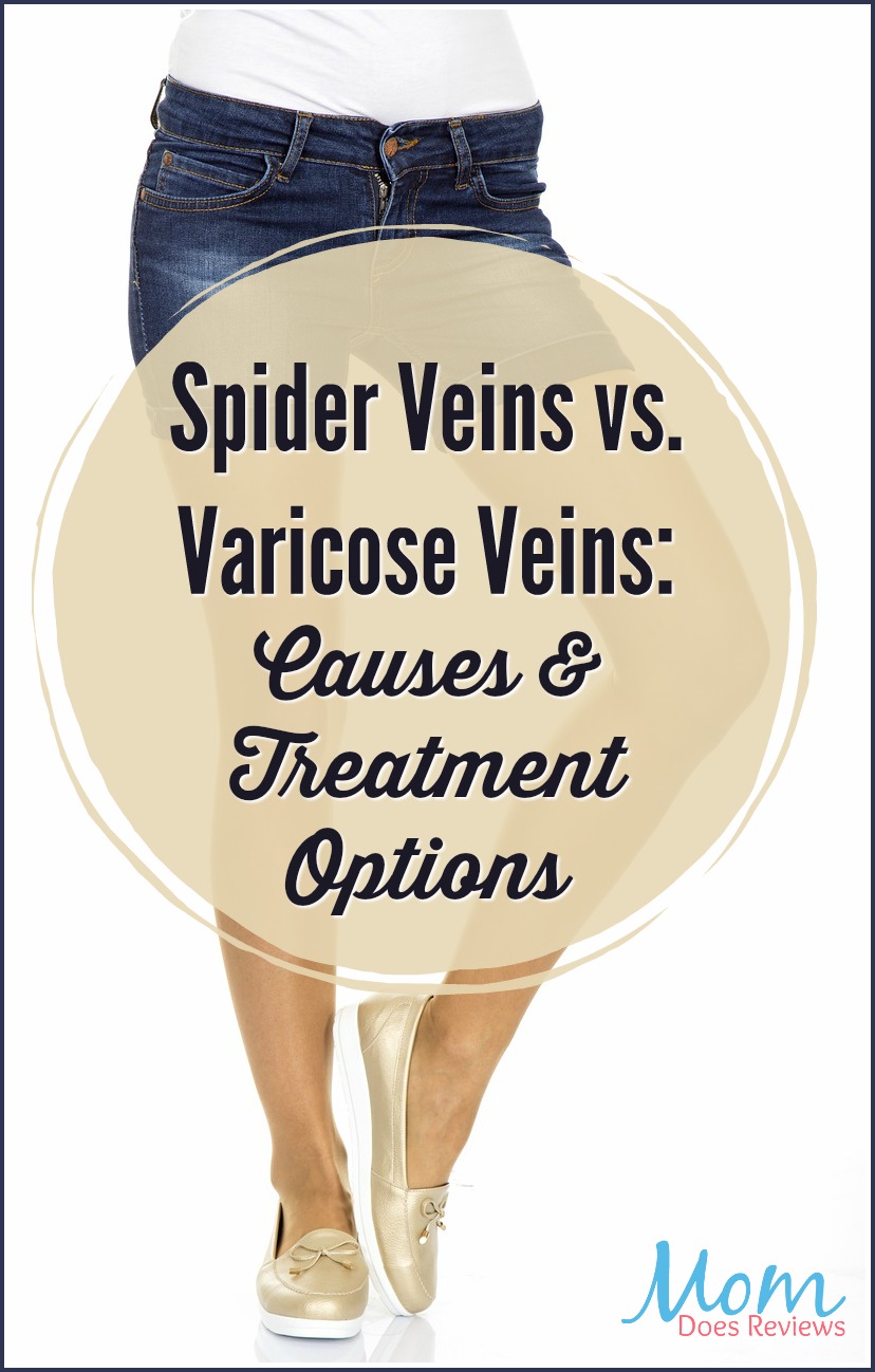 Spider Veins vs. Varicose Veins: Causes and Treatment Options