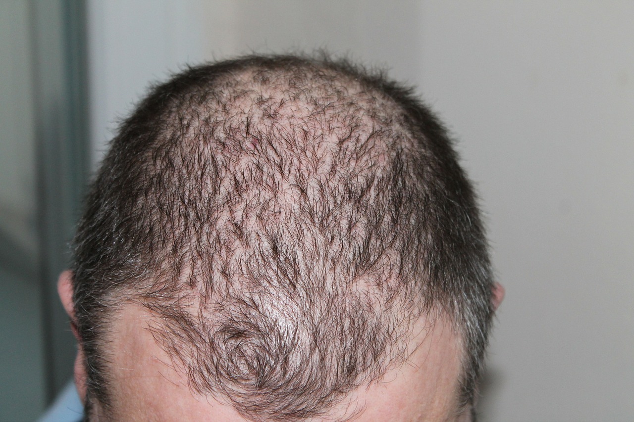 What to Expect from Restoring your Hair- Basic Aspects of a Hair Transplant
