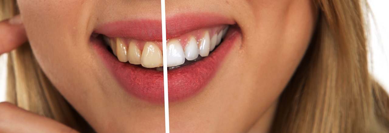 How to Achieve Pearly Whites in the Comfort of Your Own Home